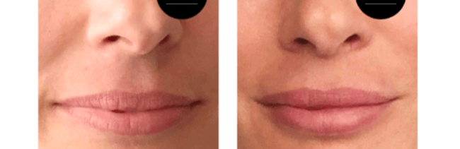 Magasinet SKØN tester Restylane læbefiller hos N’AGE