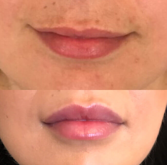 Få de smukkeste læber med unik behandlingsteknik!