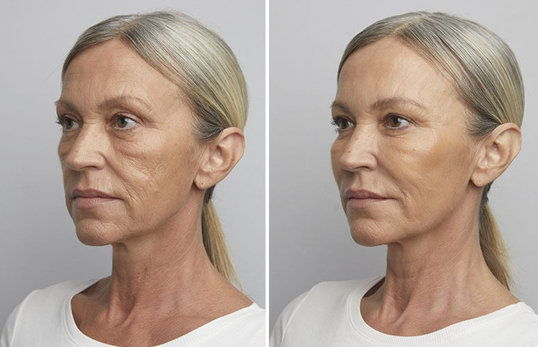 Restylane og botox