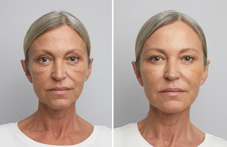 Restylane og botox