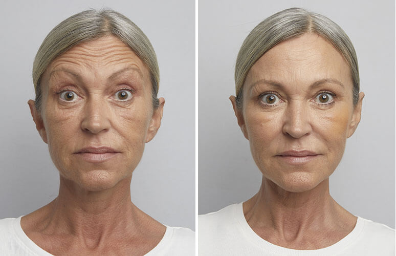 Restylane og botox