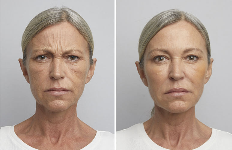 Restylane og botox