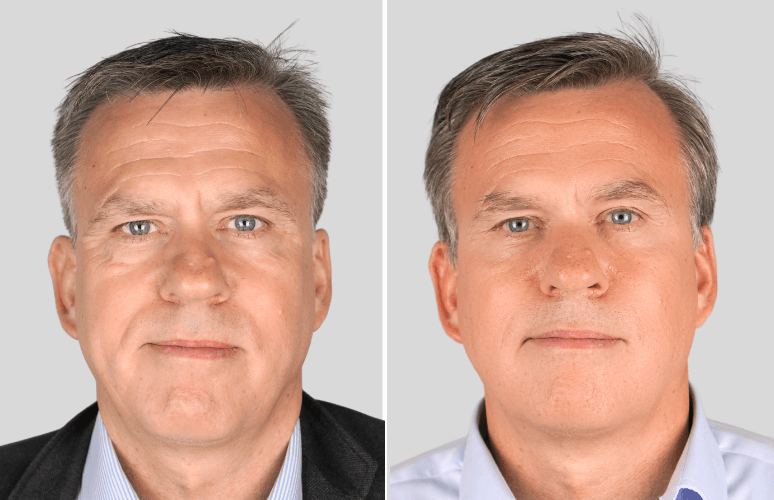Botox