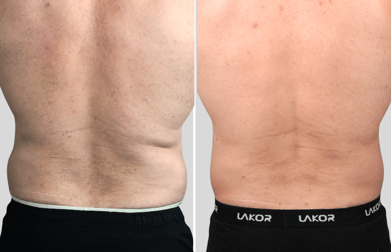 CoolSculpting