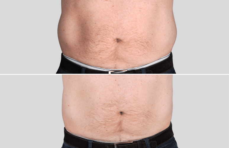 CoolSculpting