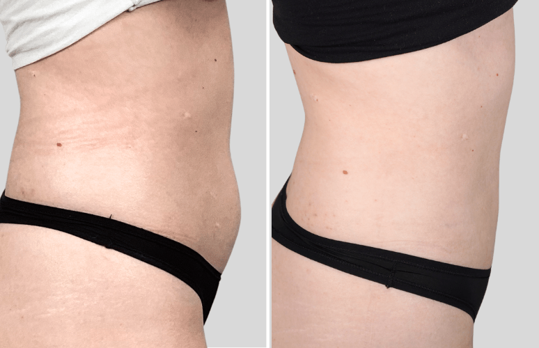 CoolSculpting