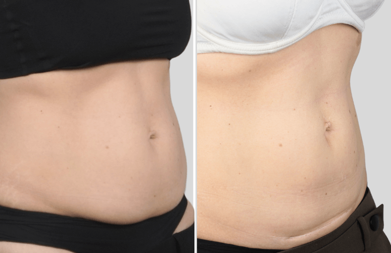 CoolSculpting