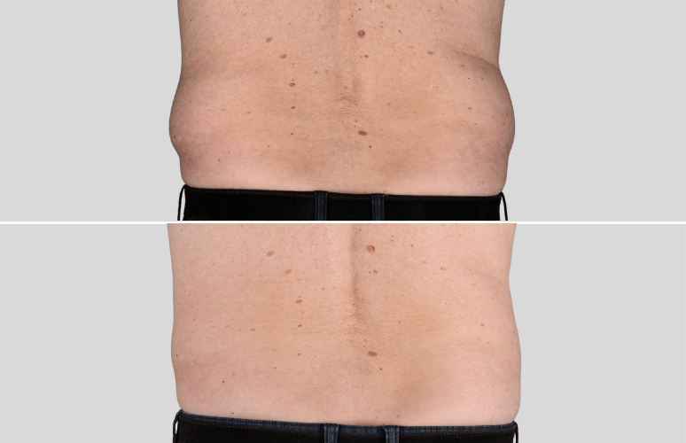 CoolSculpting