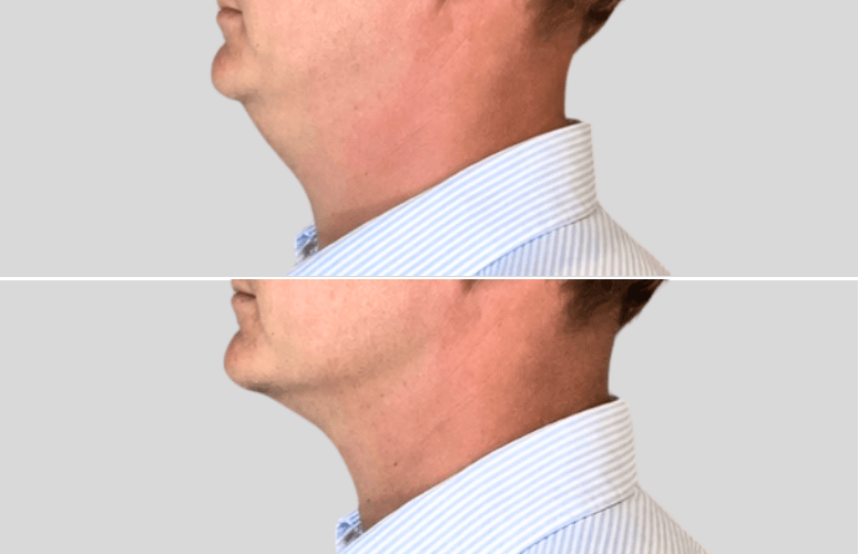 CoolSculpting
