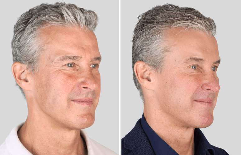 Botox