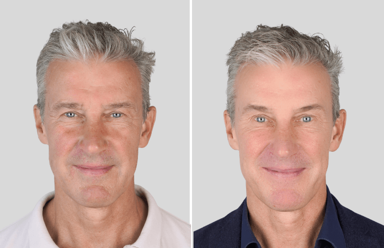 Botox