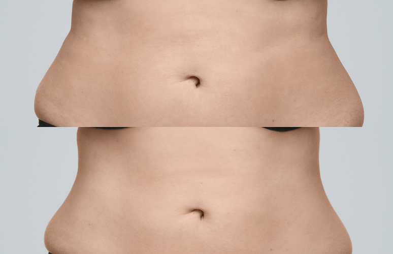 Coolsculpting mave - før og efter