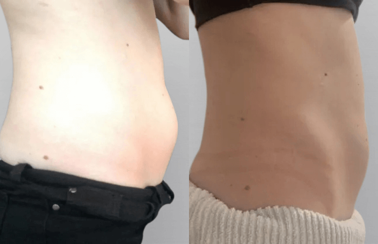 Fedtfrysning mave - før og efter