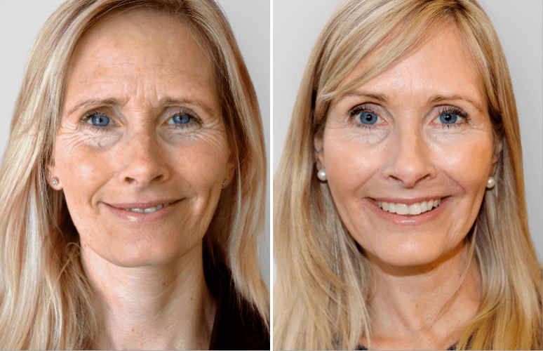 Restylane Skinbooster 