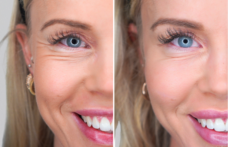 Teosyal mod poser under øjnene