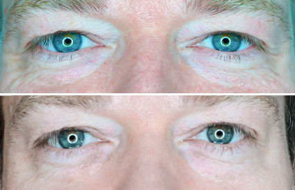 Sunekos mod poser under øjnene