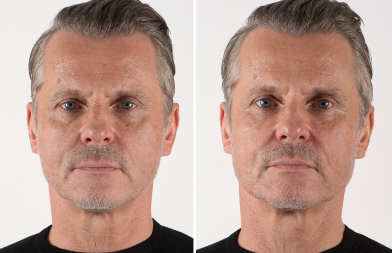 Teosyal mod poser under øjnene