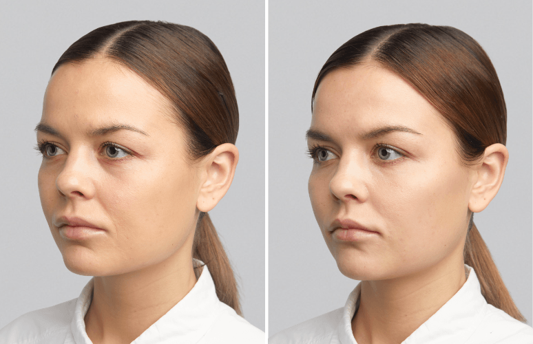 Restylane 