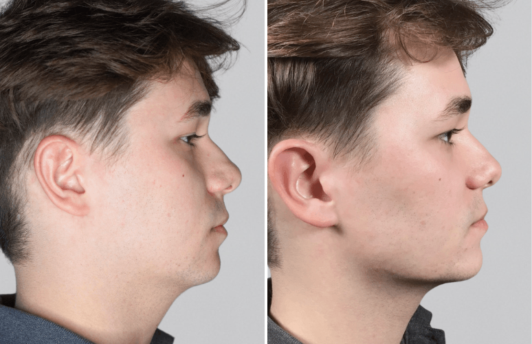 Restylane 