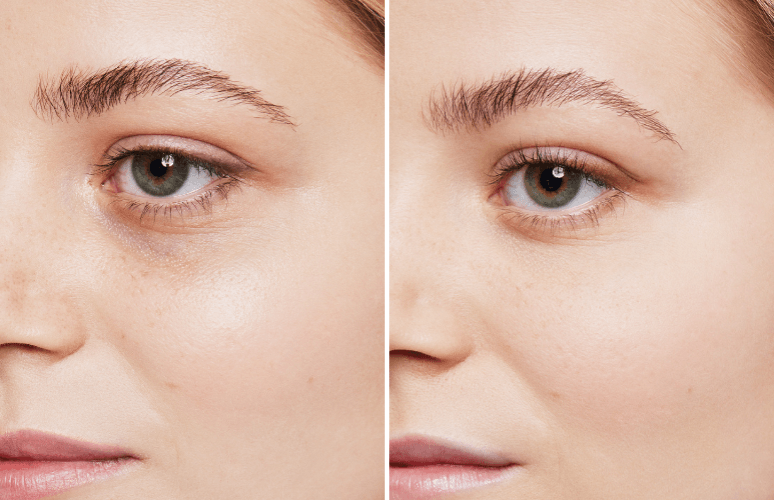 Restylane 