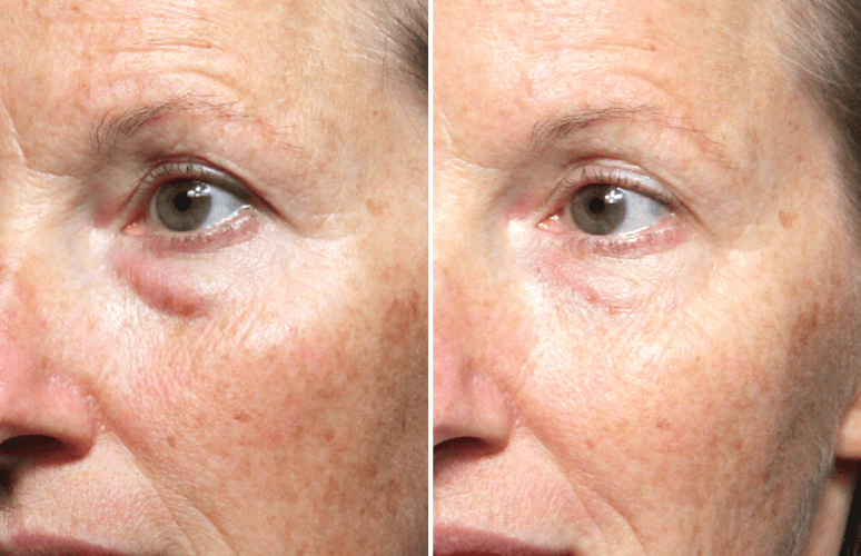 Restylane 