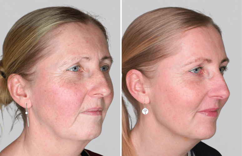 Restylane 