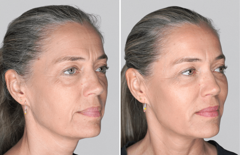 Restylane 