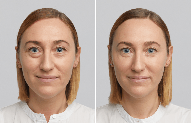 Restylane 