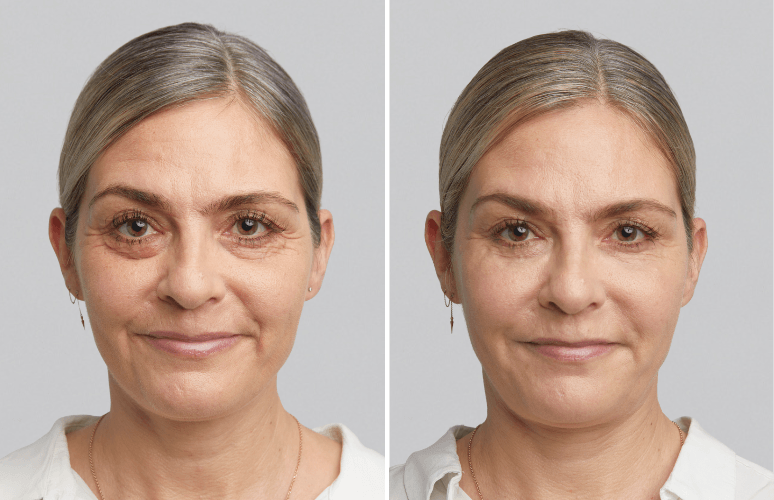 Restylane 