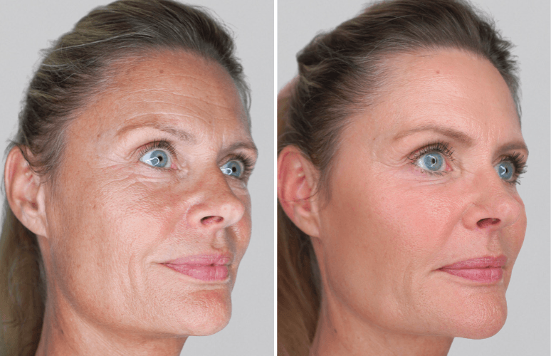 Restylane 