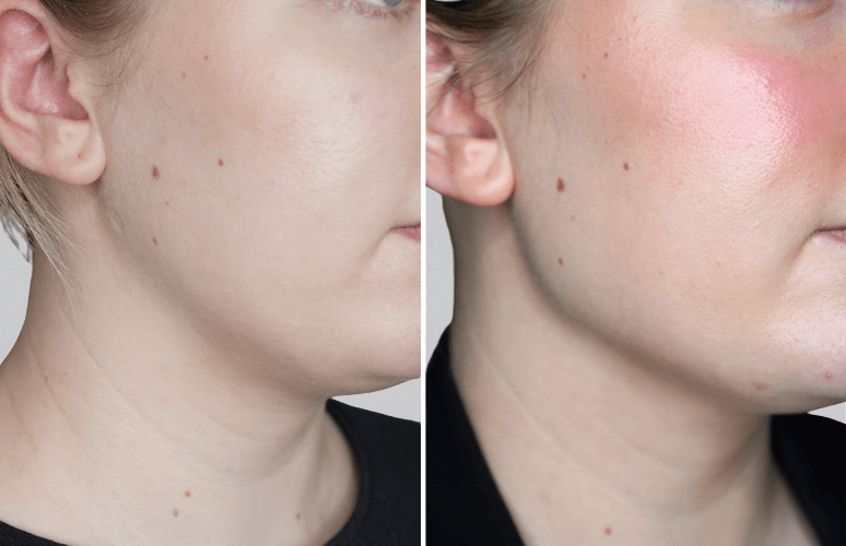 Restylane 