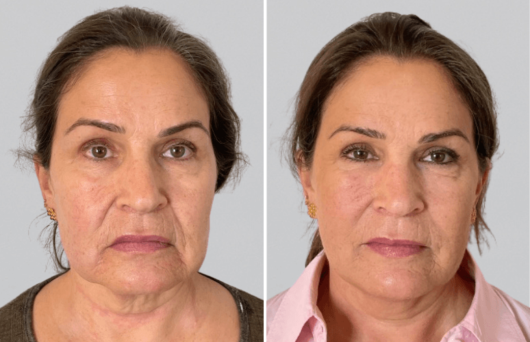 Restylane 