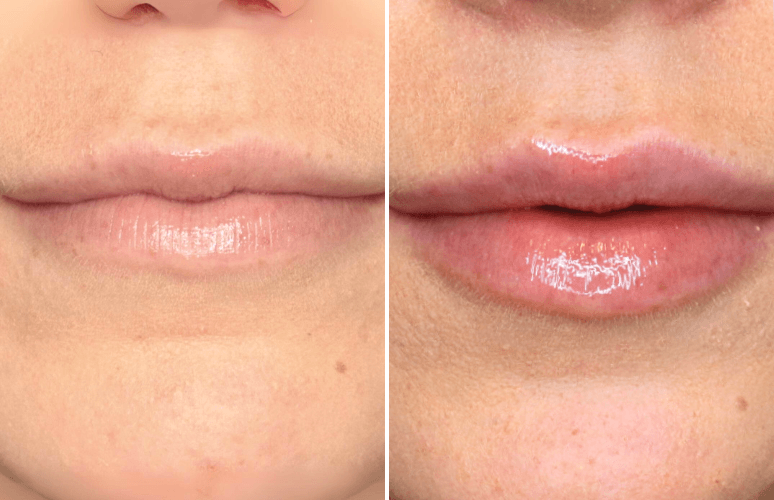 Restylane