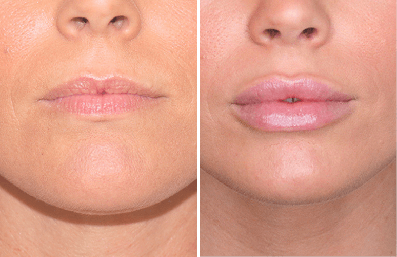 Restylane