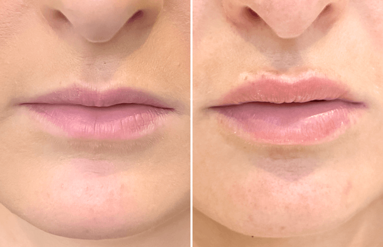 Restylane