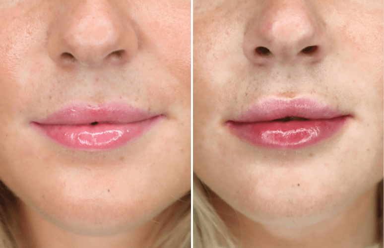 Restylane