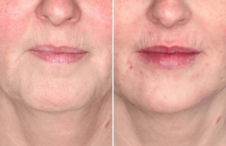 Restylane