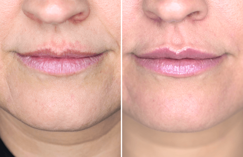 Restylane