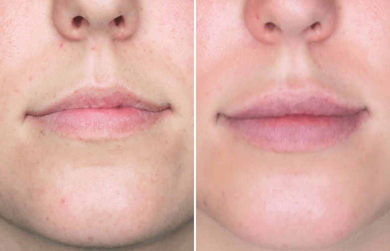 Restylane