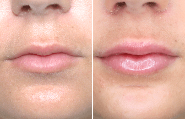 Restylane 