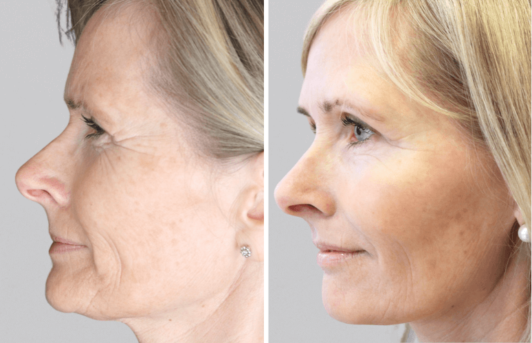 Restylane Skinbooster & Botox