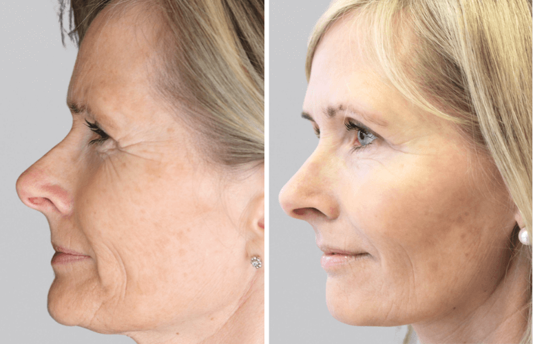 Restylane Skinbooster