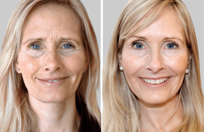 Restylane Skinbooster & Botox