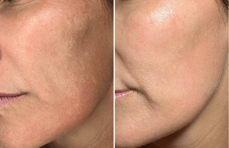 dual frax laser n'age