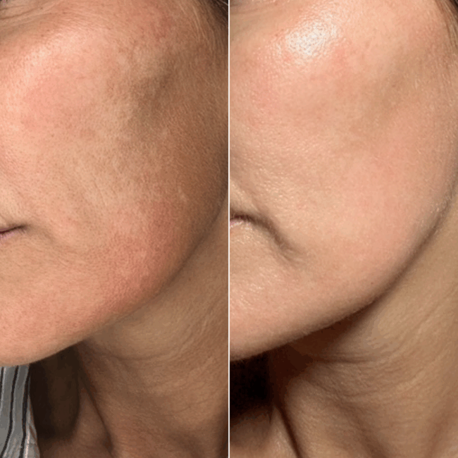 caroline dual frax nage