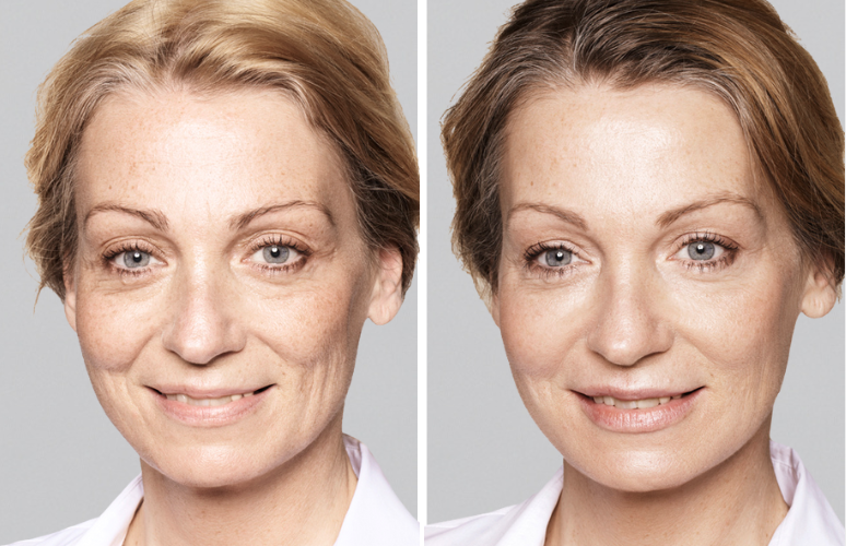 Restylane Skinbooster