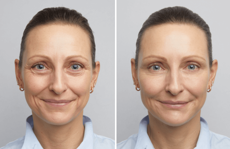 Filler-behandling med Restylane
