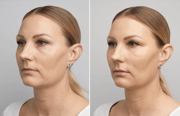 Filler-behandling med Restylane