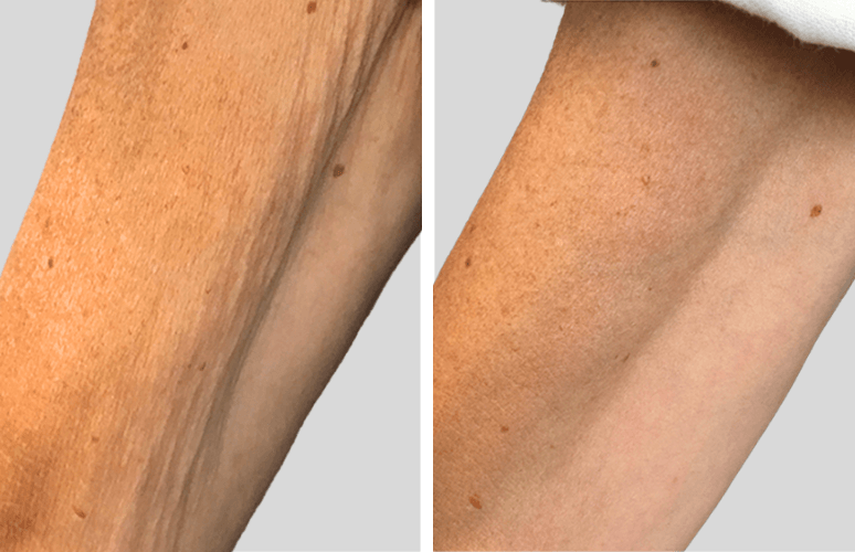 Kunden er behandlet med Profhilo body på underarmen.