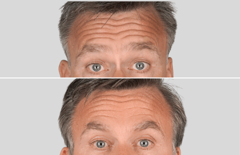 Botox